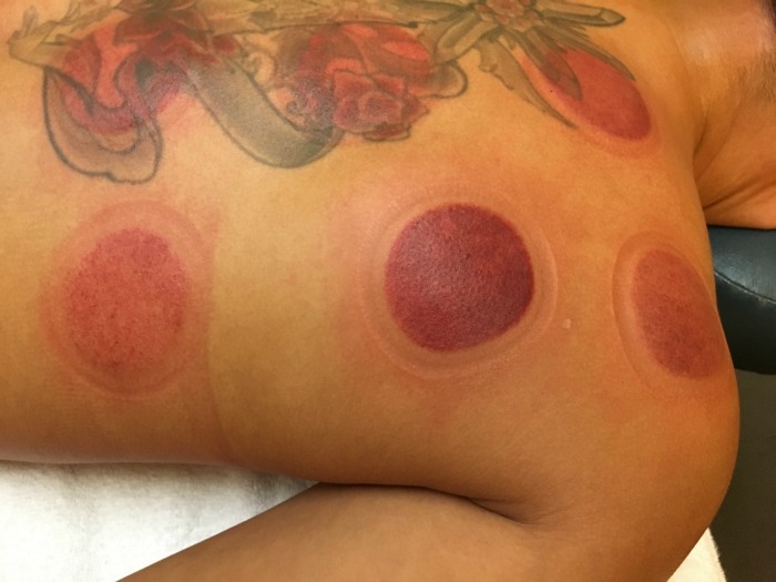 Cupping