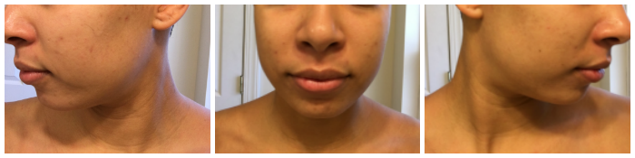 yoderm-progress